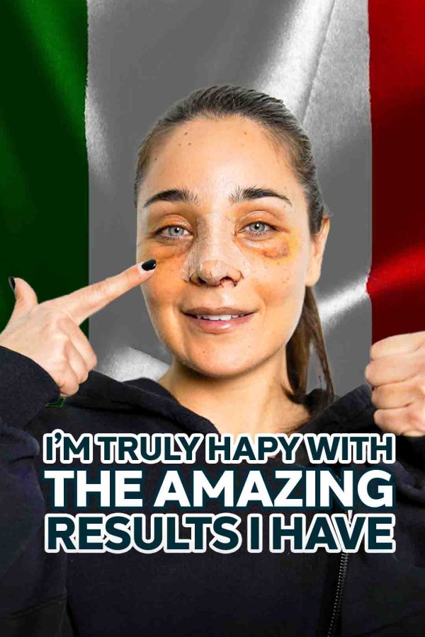 Valentina’s Rhinoplasty Journey: Italy to Turkey!
