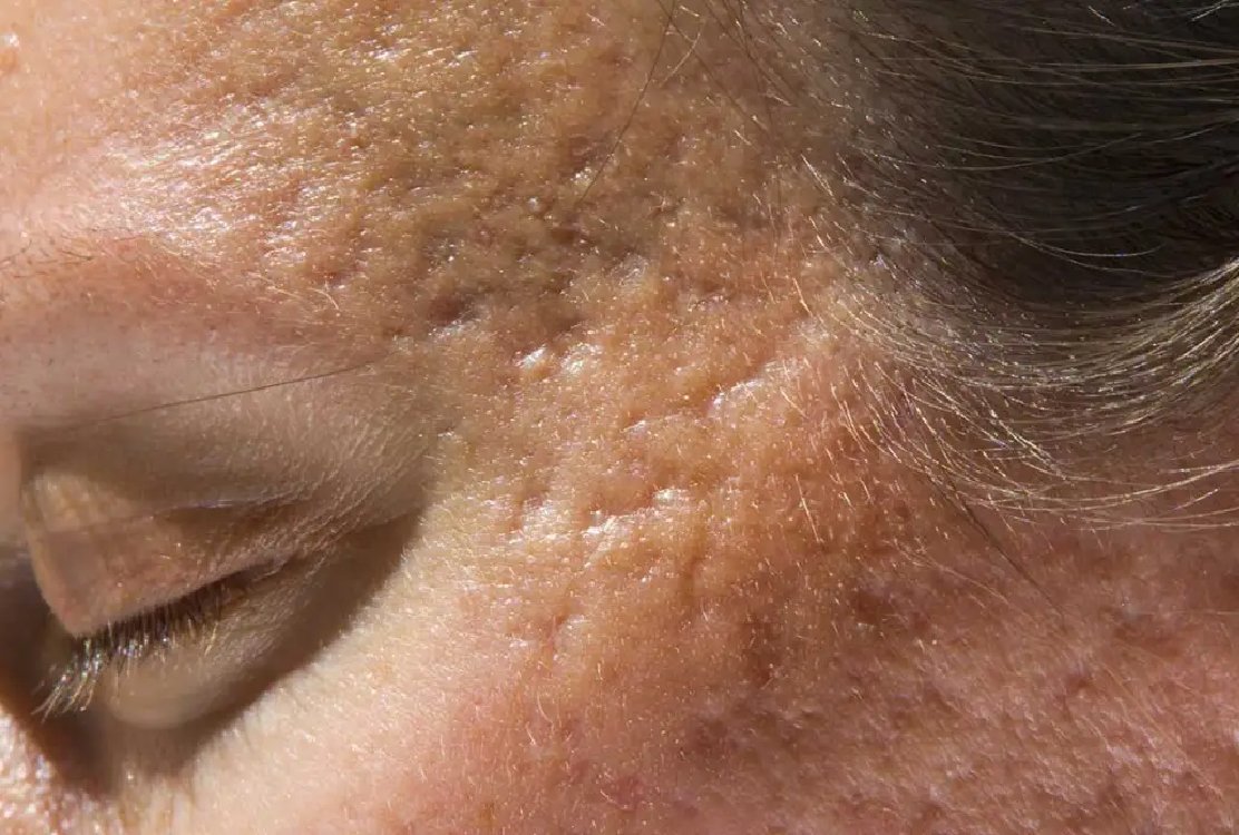 Acne_scars_for_scar_revision_in_turkey