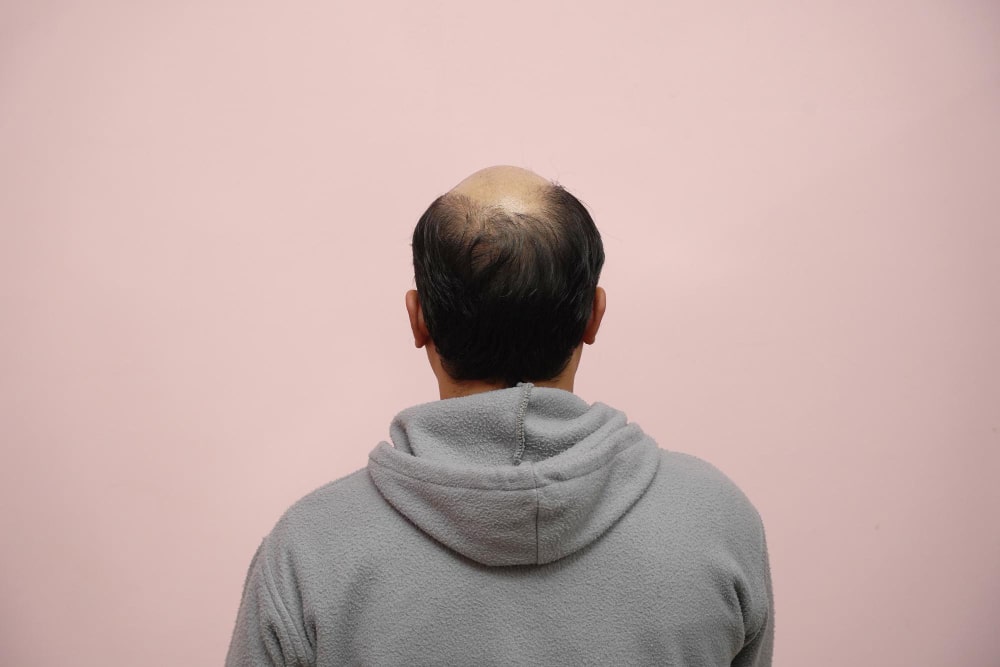 bald_man_with_good_donnor_area_for_dhi_hair_transplant_in_turkey