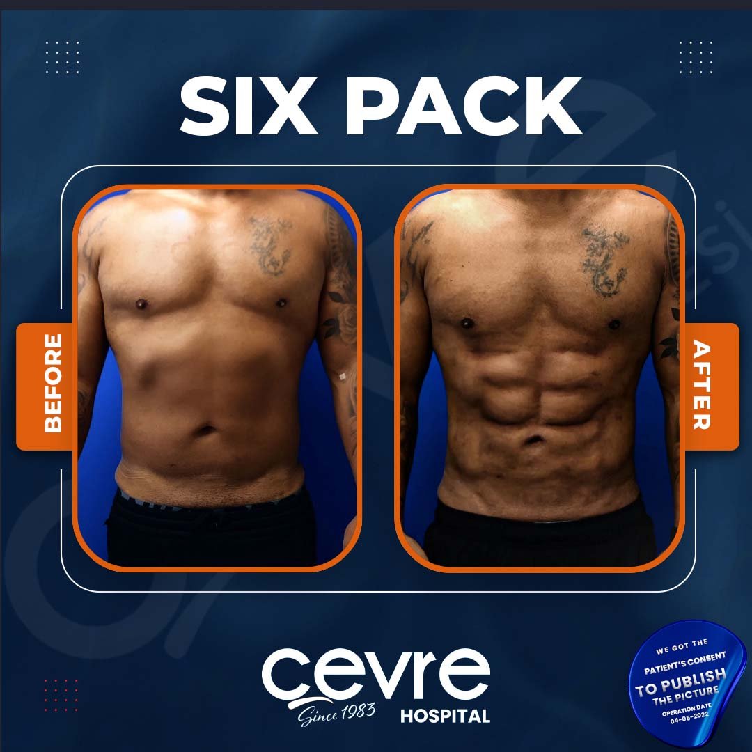 2024 Six Pack Surgery (Abdominal Etching) in Turkey Cost and Updates!