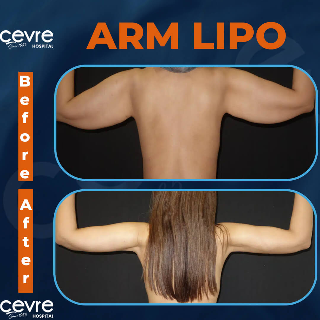 before_and_after_arm_lipo_in_turkey (5)