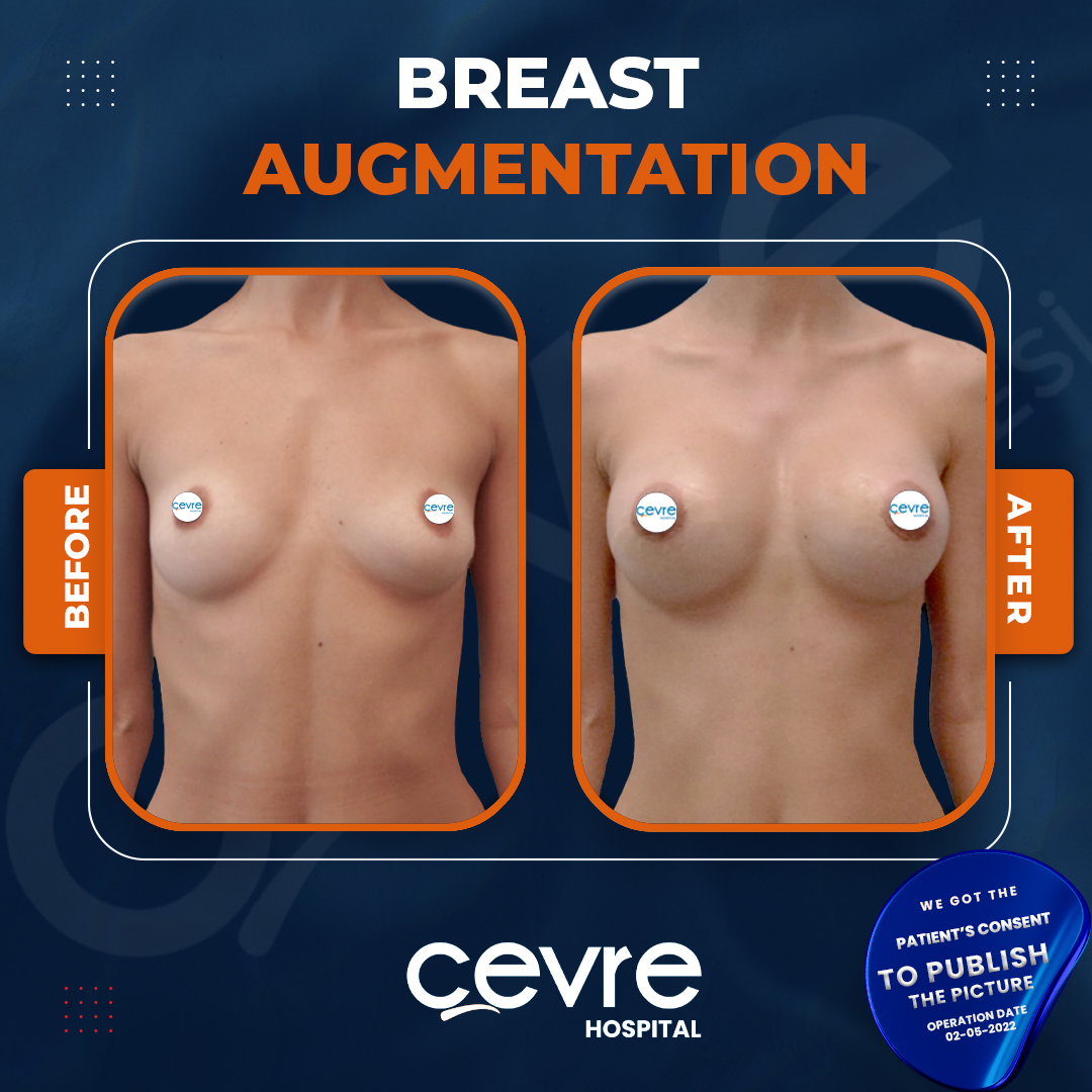 before_and_after_breast_augmentation_in_turkey_with_cevre_hospital (6)
