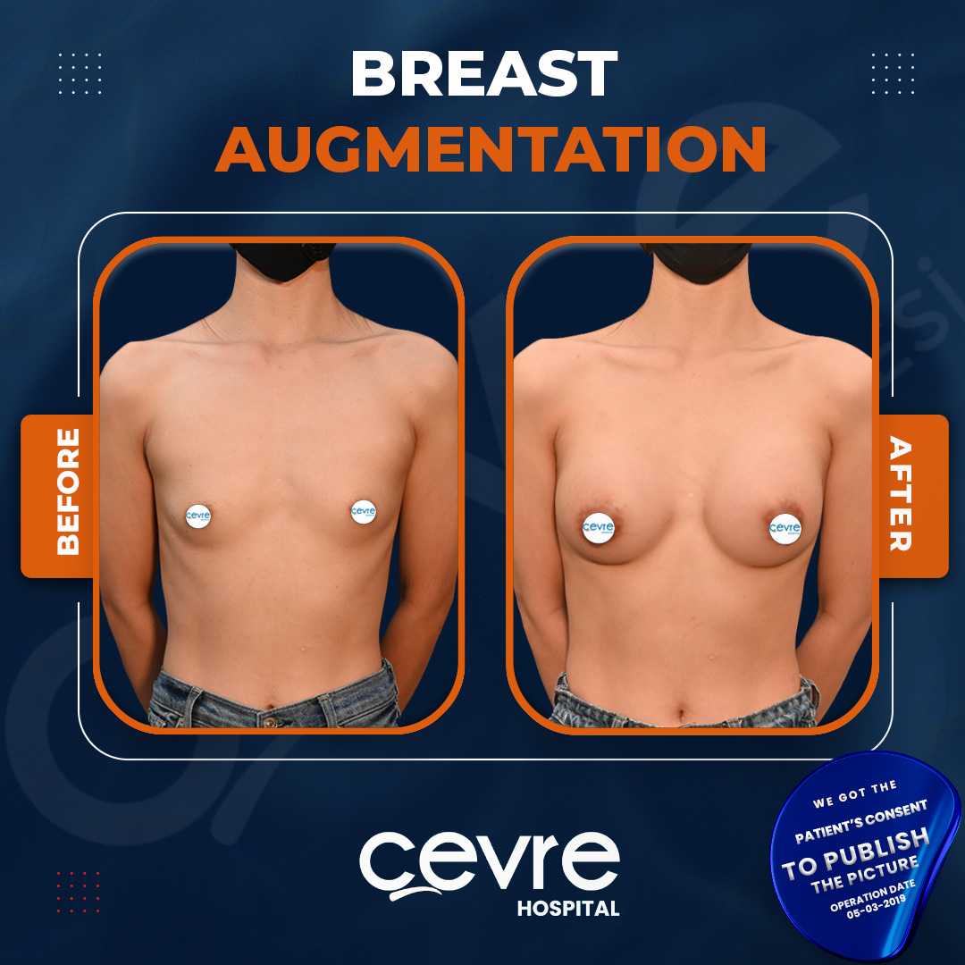 before_and_after_breast_augmentation_in_turkey_with_cevre_hospital