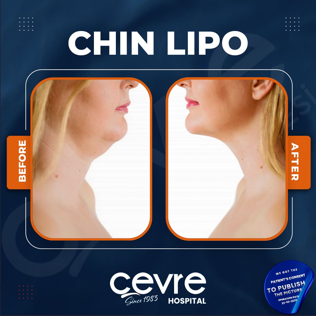 before_and_after_chin_lipo_in_turkey (5)