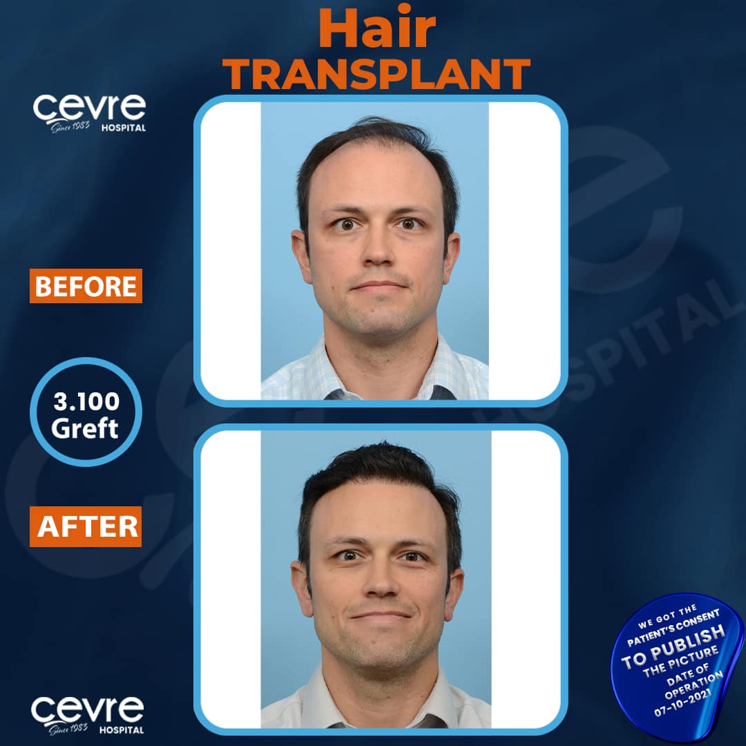 before_and_after_dhi_hair_transplant_in_turkey (3)