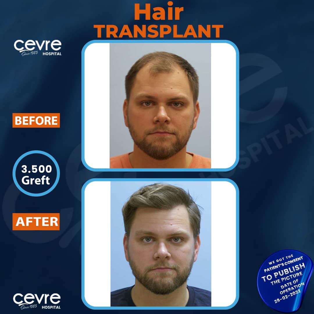 before_and_after_dhi_hair_transplant_in_turkey (4)