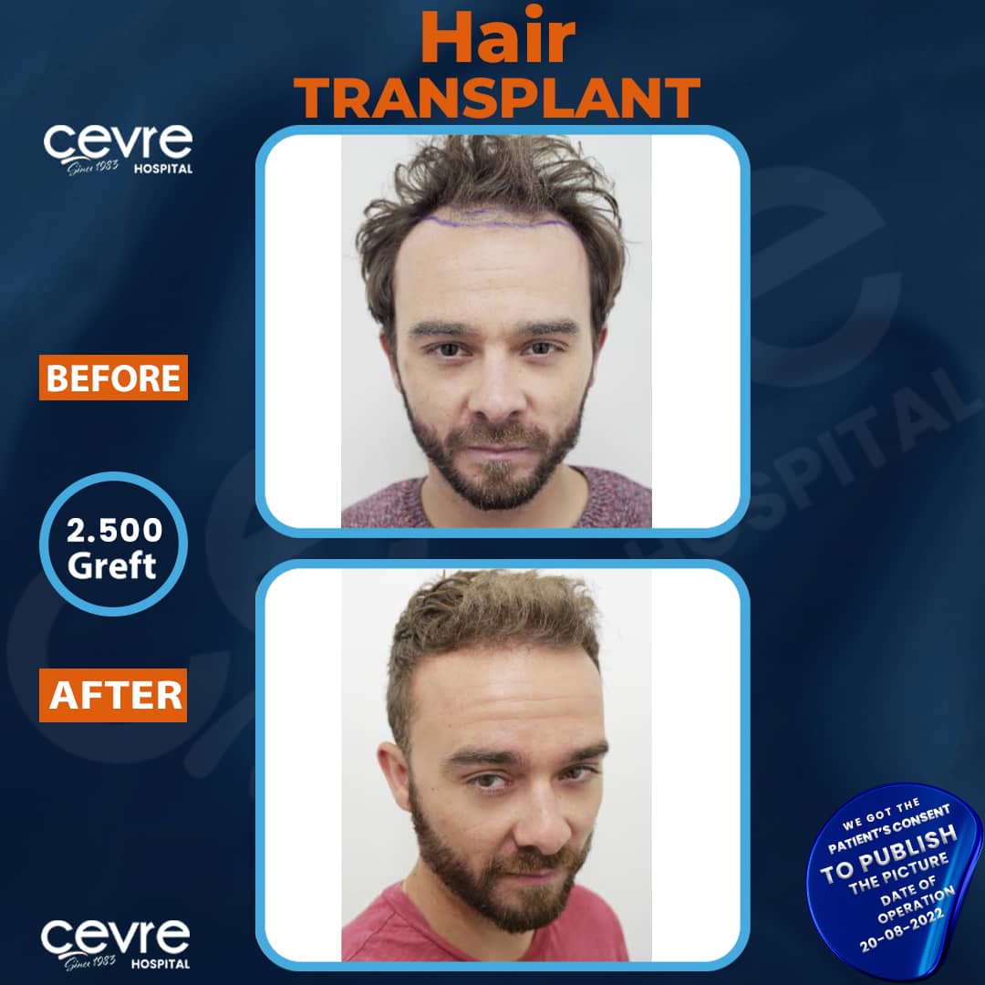 before_and_after_dhi_hair_transplant_in_turkey (7)