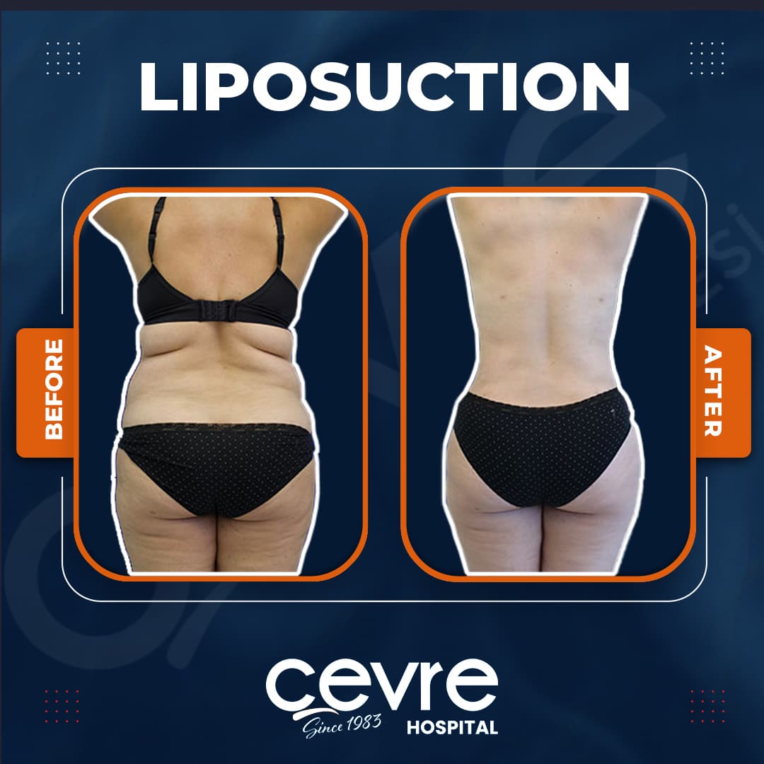 before_and_after_lipo_in_turkey (3)