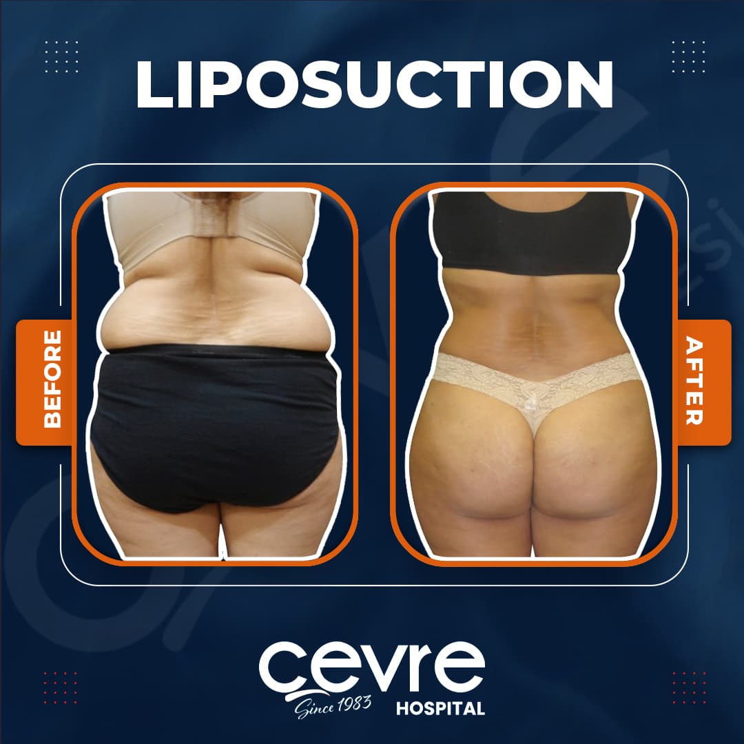 before_and_after_lipo_in_turkey
