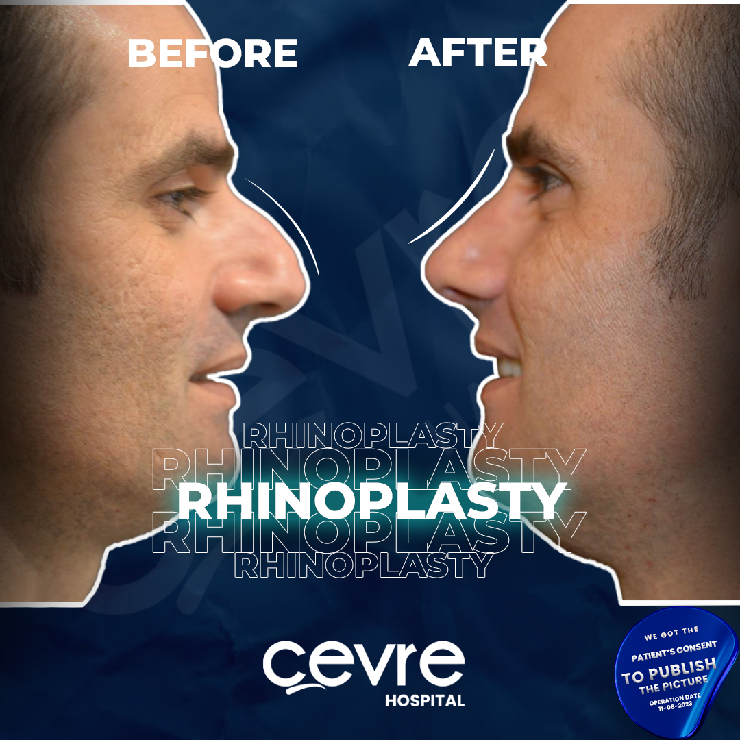 before_and_after_pic_of_man_with_piezo_rhinoplasty_in_turkey