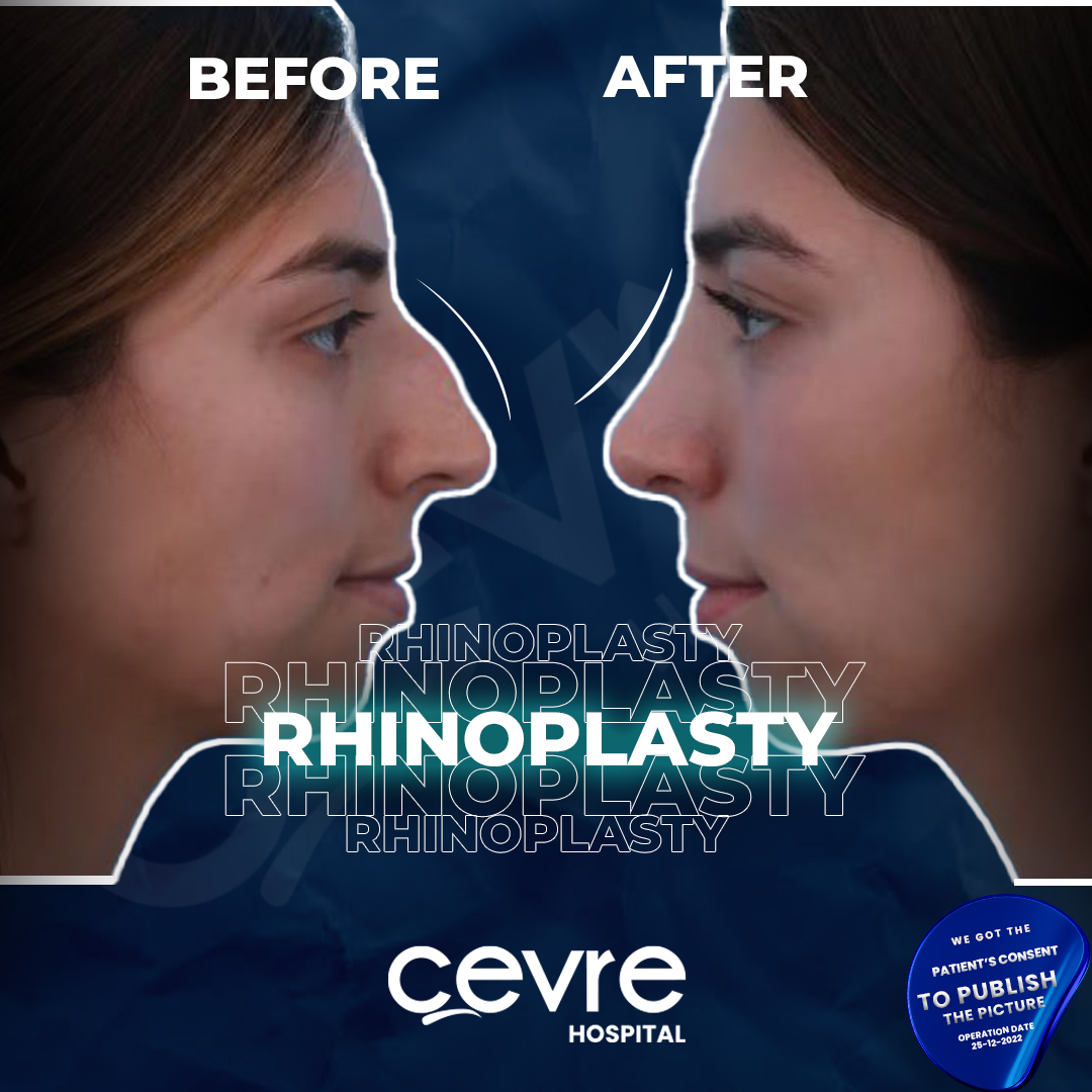 before_and_after_pic_of_woman_with_piezo_rhinoplasty_in_turkey (2)