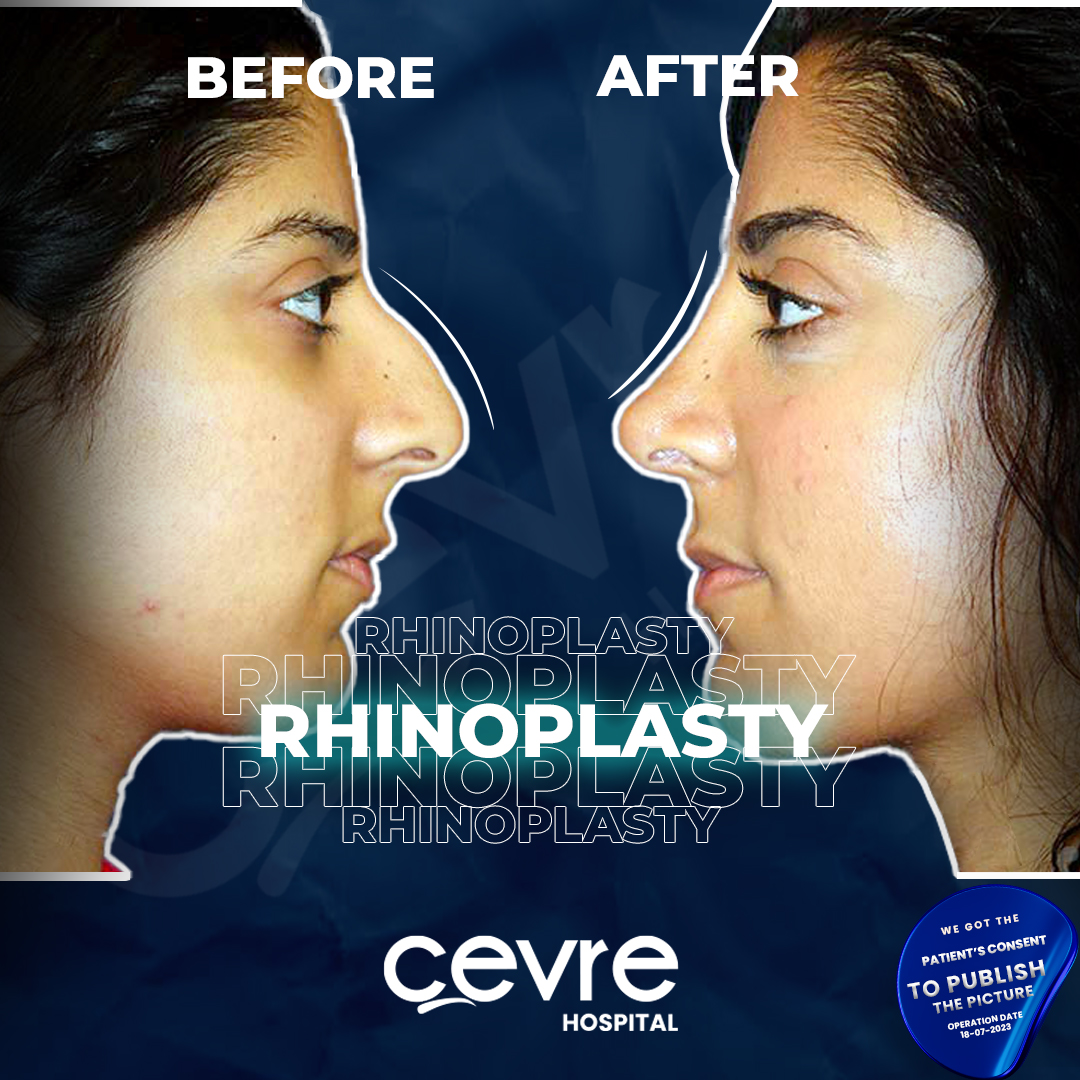 before_and_after_pic_of_woman_with_piezo_rhinoplasty_in_turkey (3)