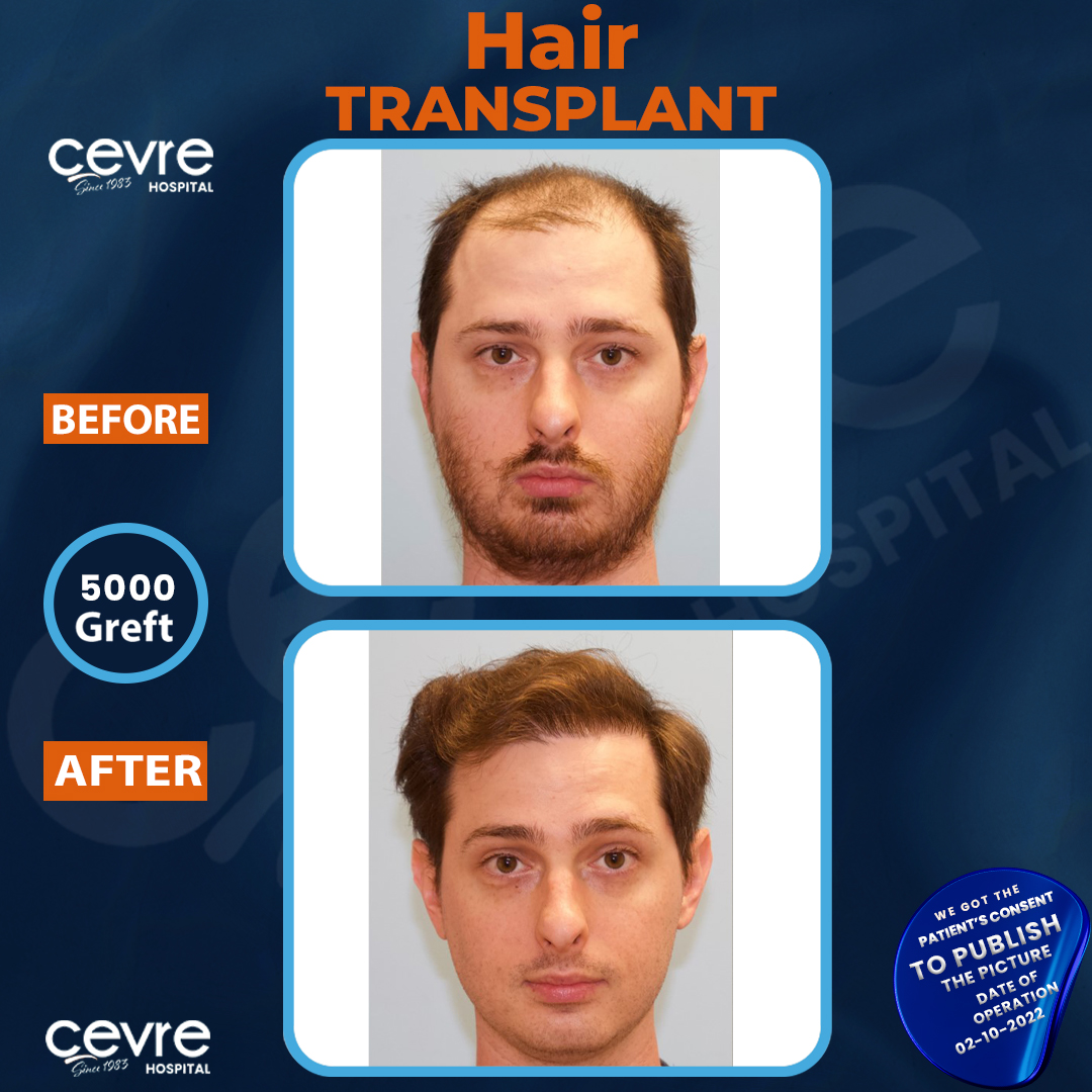 before_and_after_picture_of_male_fue_hair_transplant_in_turkey (13)