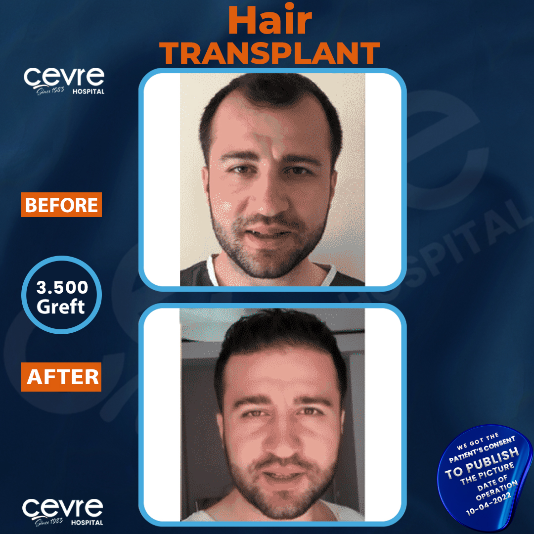 before_and_after_picture_of_male_fue_hair_transplant_in_turkey (18)