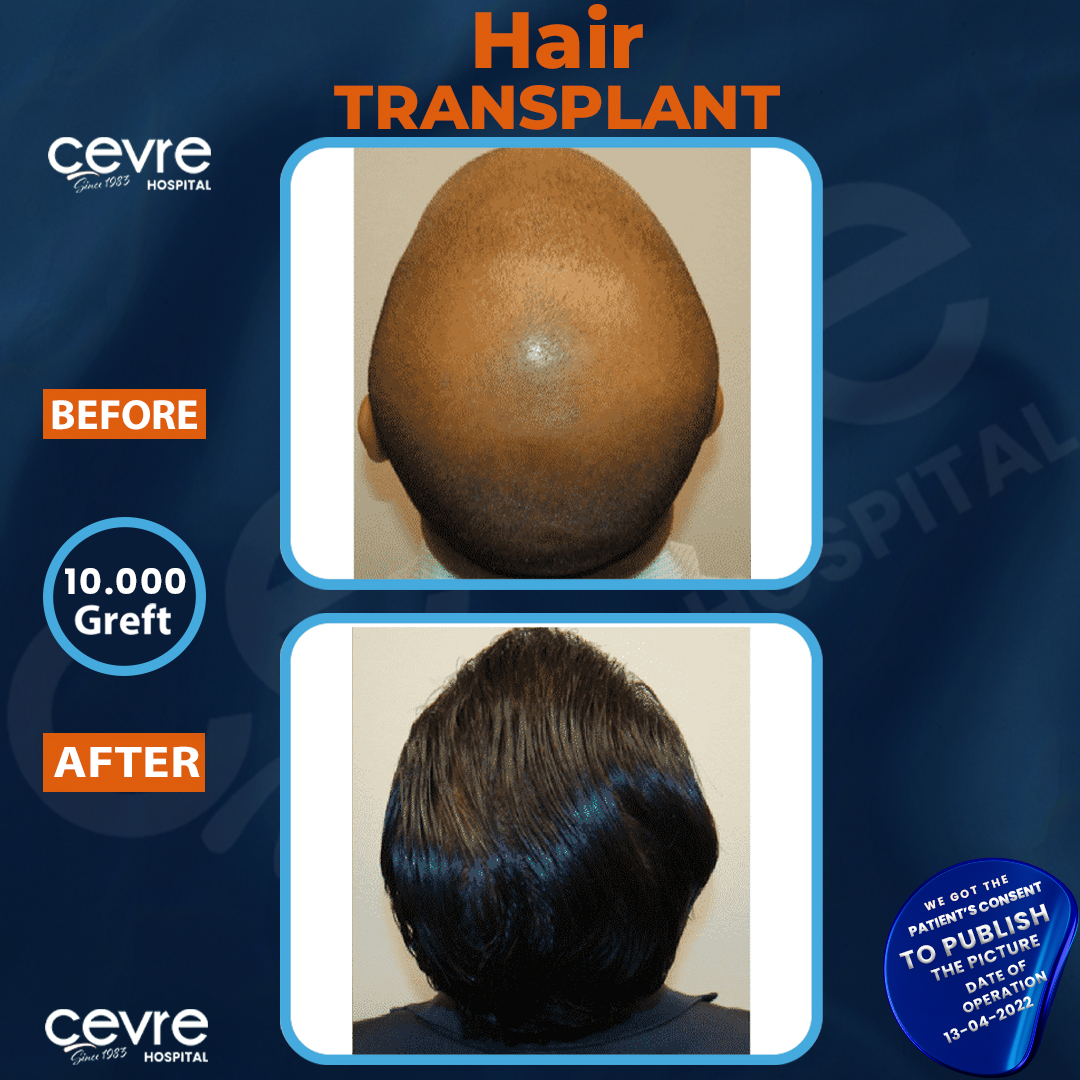 before_and_after_picture_of_male_fue_hair_transplant_in_turkey (19)