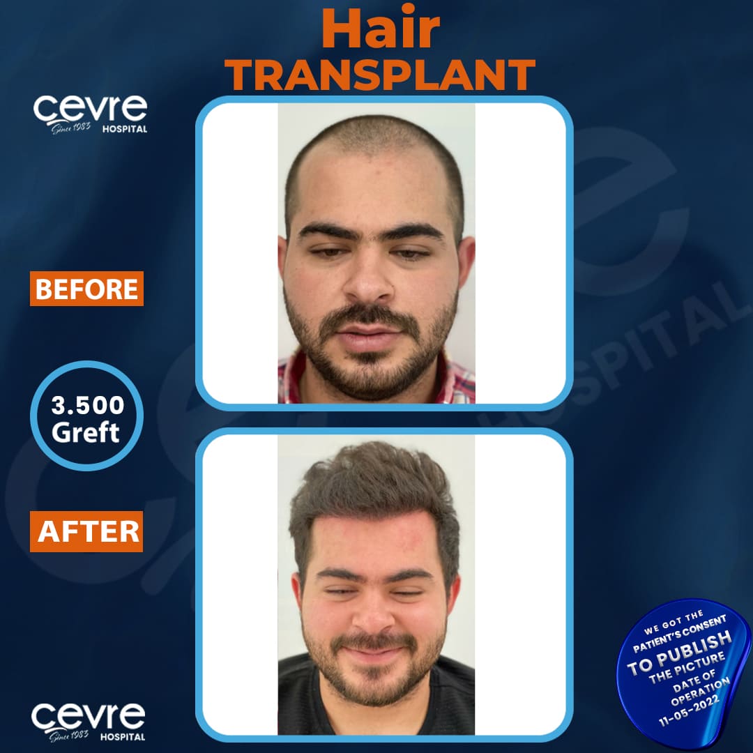 before_and_after_picture_of_male_hair_transplant_in_turkey (2)