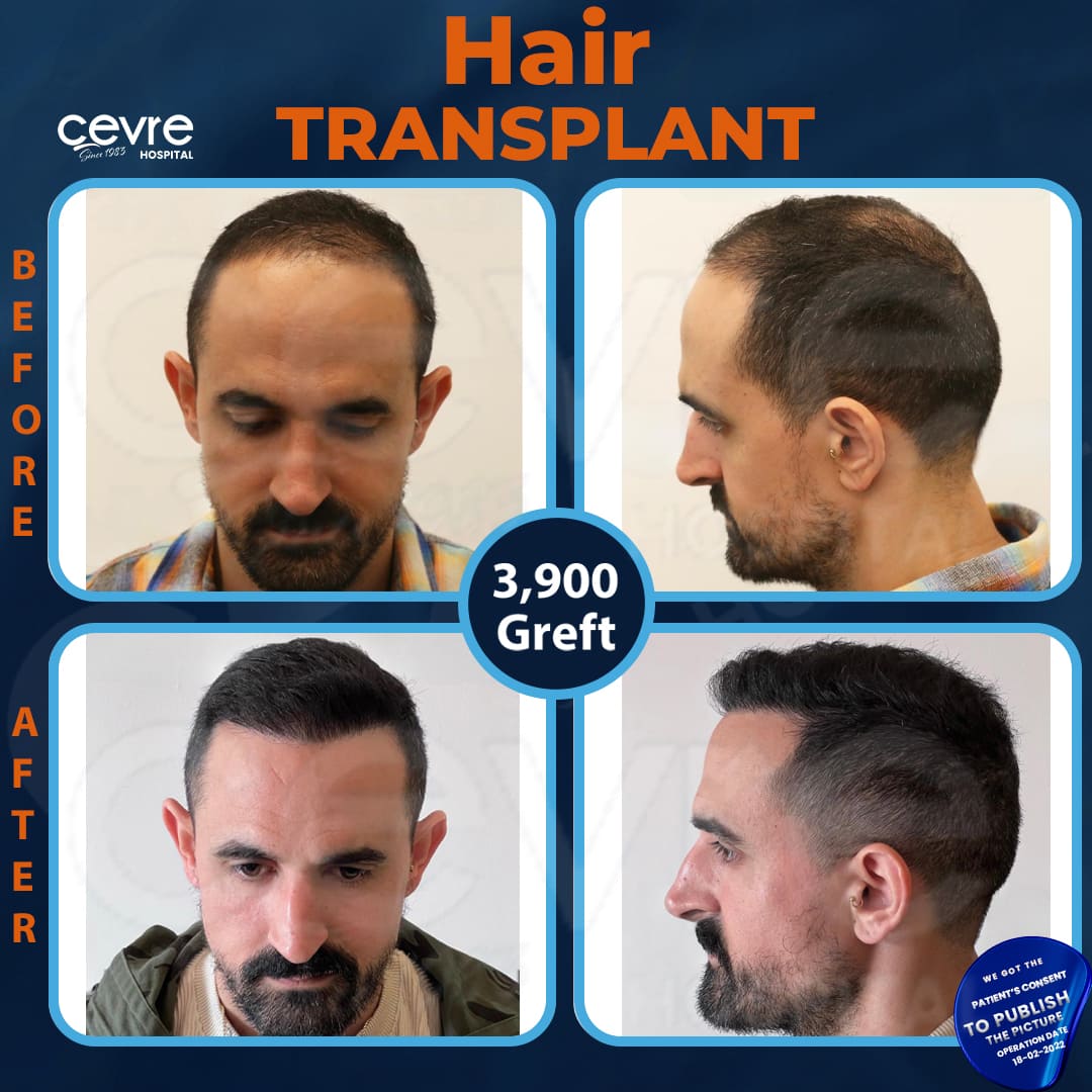 before_and_after_picture_of_male_hair_transplant_in_turkey (4)