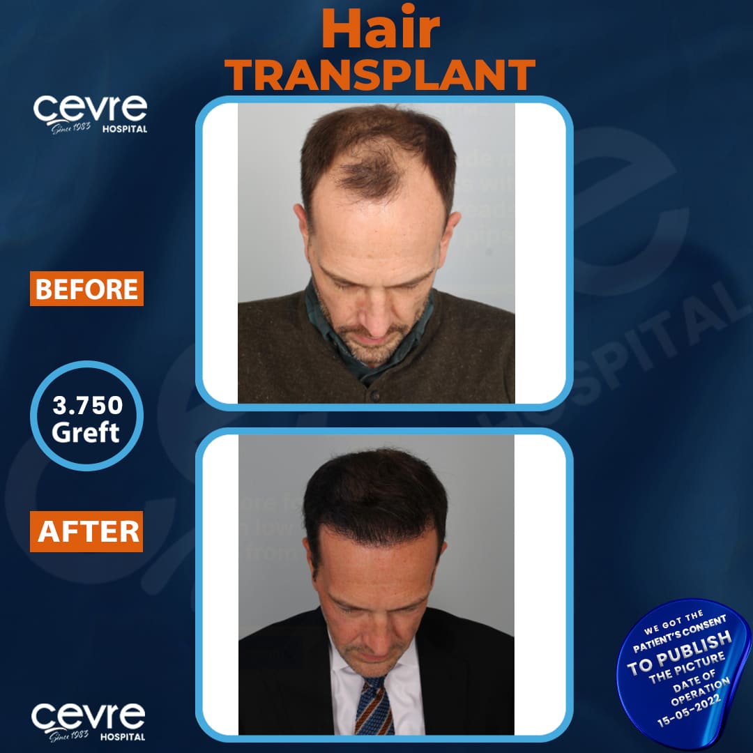 before_and_after_picture_of_male_hair_transplant_in_turkey (6)