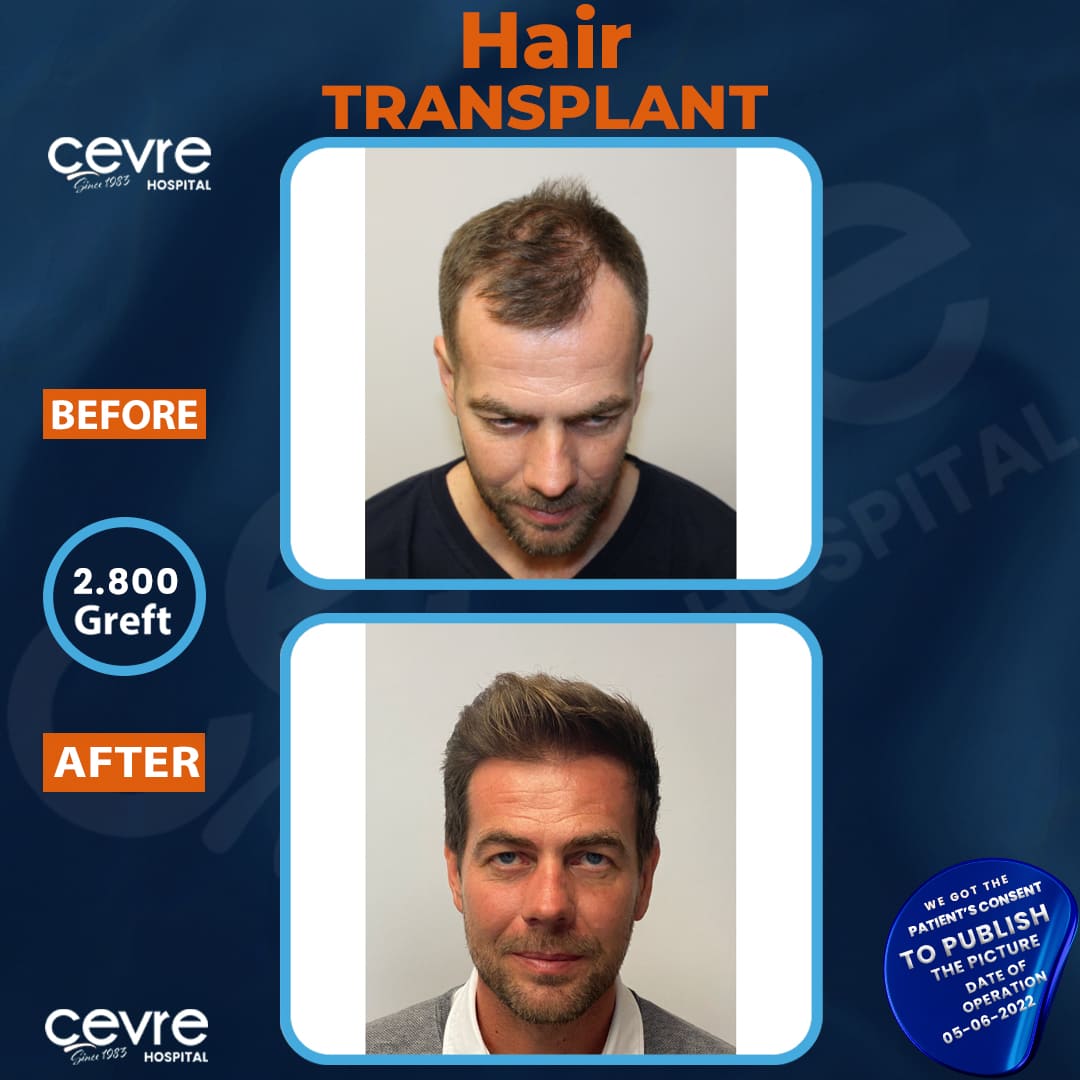 before_and_after_picture_of_male_hair_transplant_in_turkey (8)