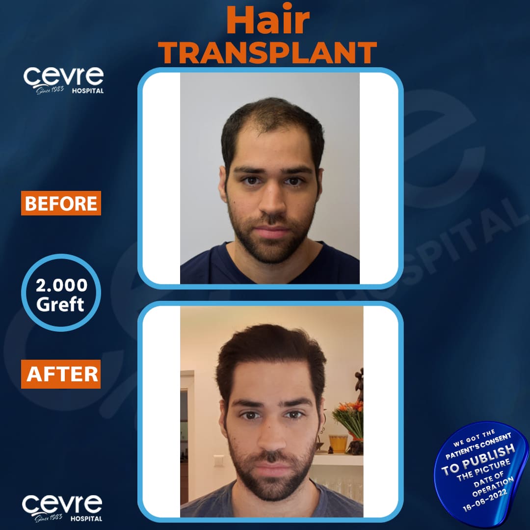 before_and_after_picture_of_male_hair_transplant_in_turkey