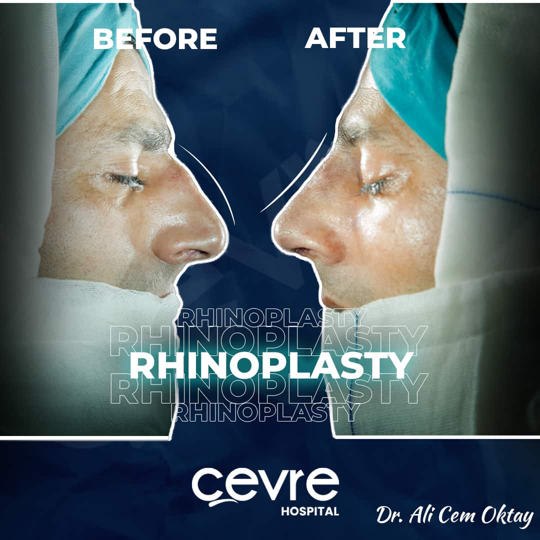 before_and_after_picture_of_revision_rhinoplasty_in_turkey_with_cevre_hospital (3)-min
