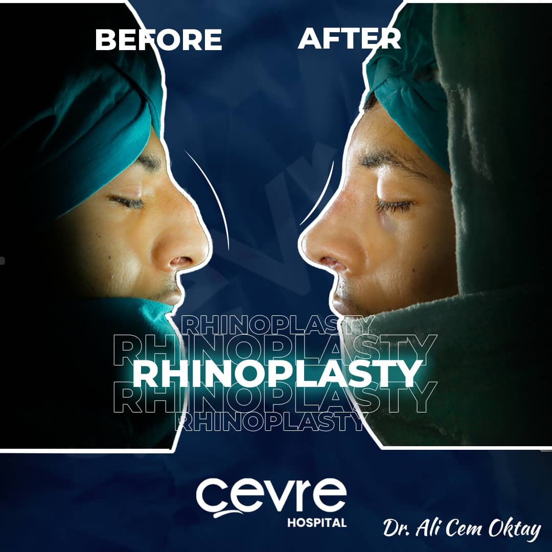 before_and_after_picture_of_revision_rhinoplasty_in_turkey_with_cevre_hospital (4)-min