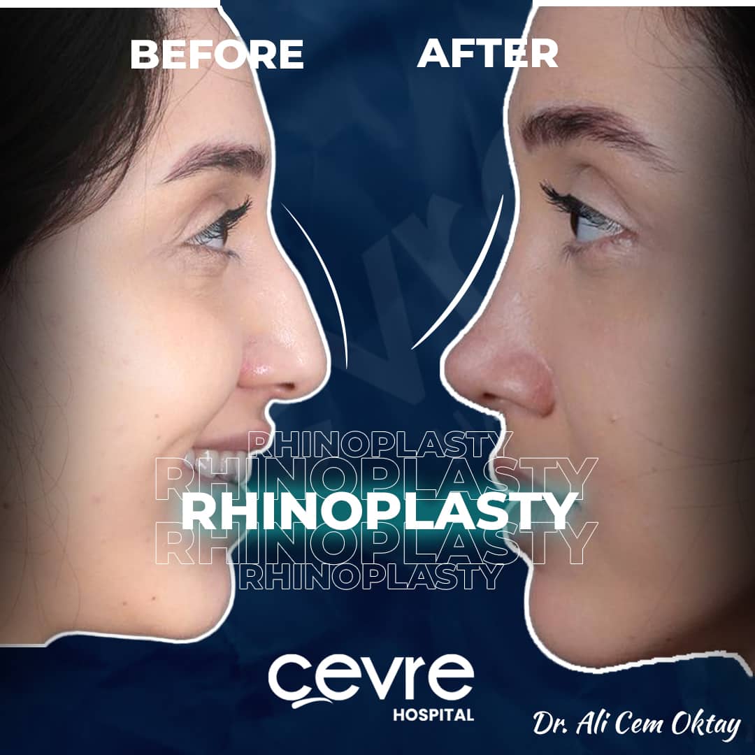 before_and_after_picture_of_revision_rhinoplasty_in_turkey_with_cevre_hospital-min