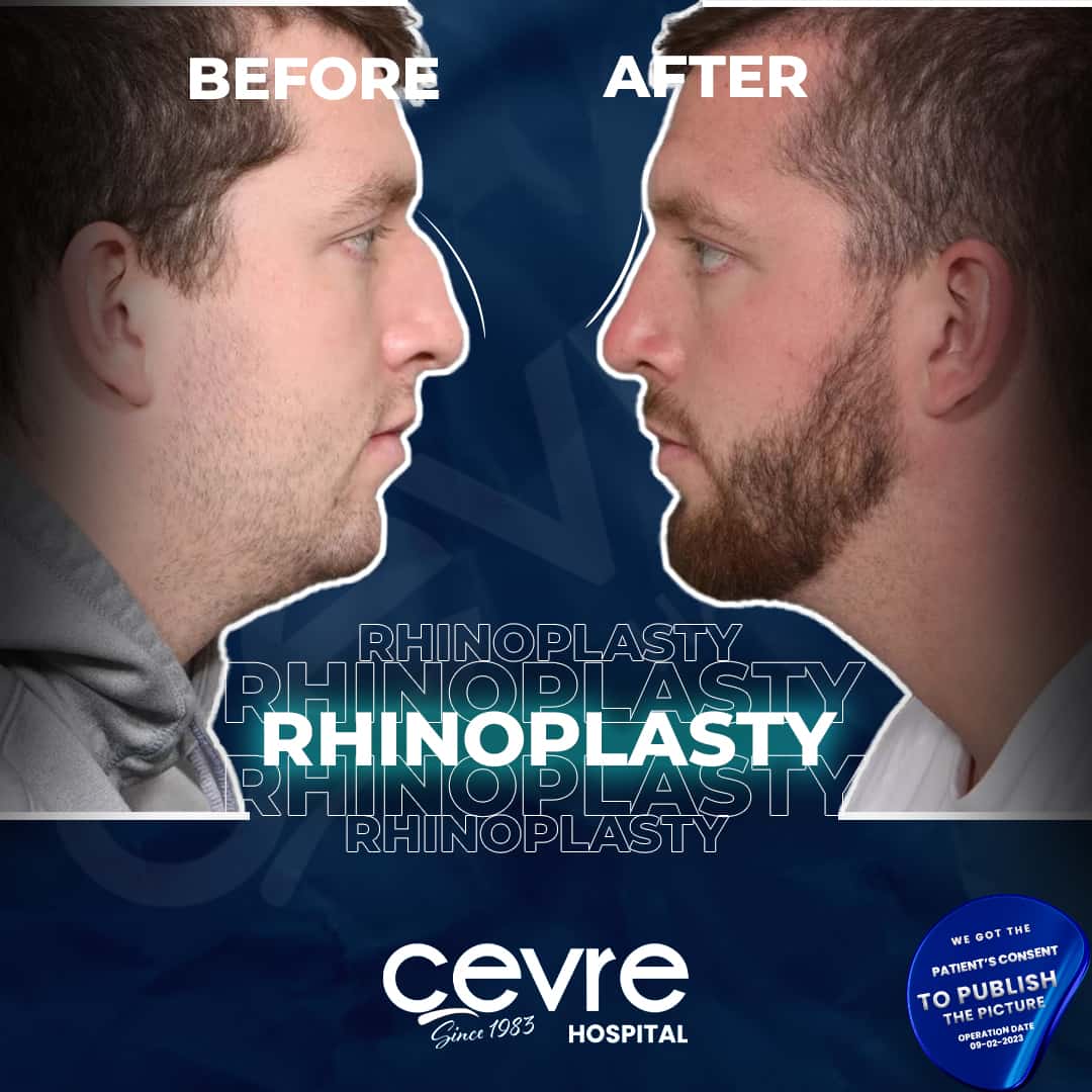 before_and_after_rhinoplasty_in_turkey_by_cevre_hospital (2)-min