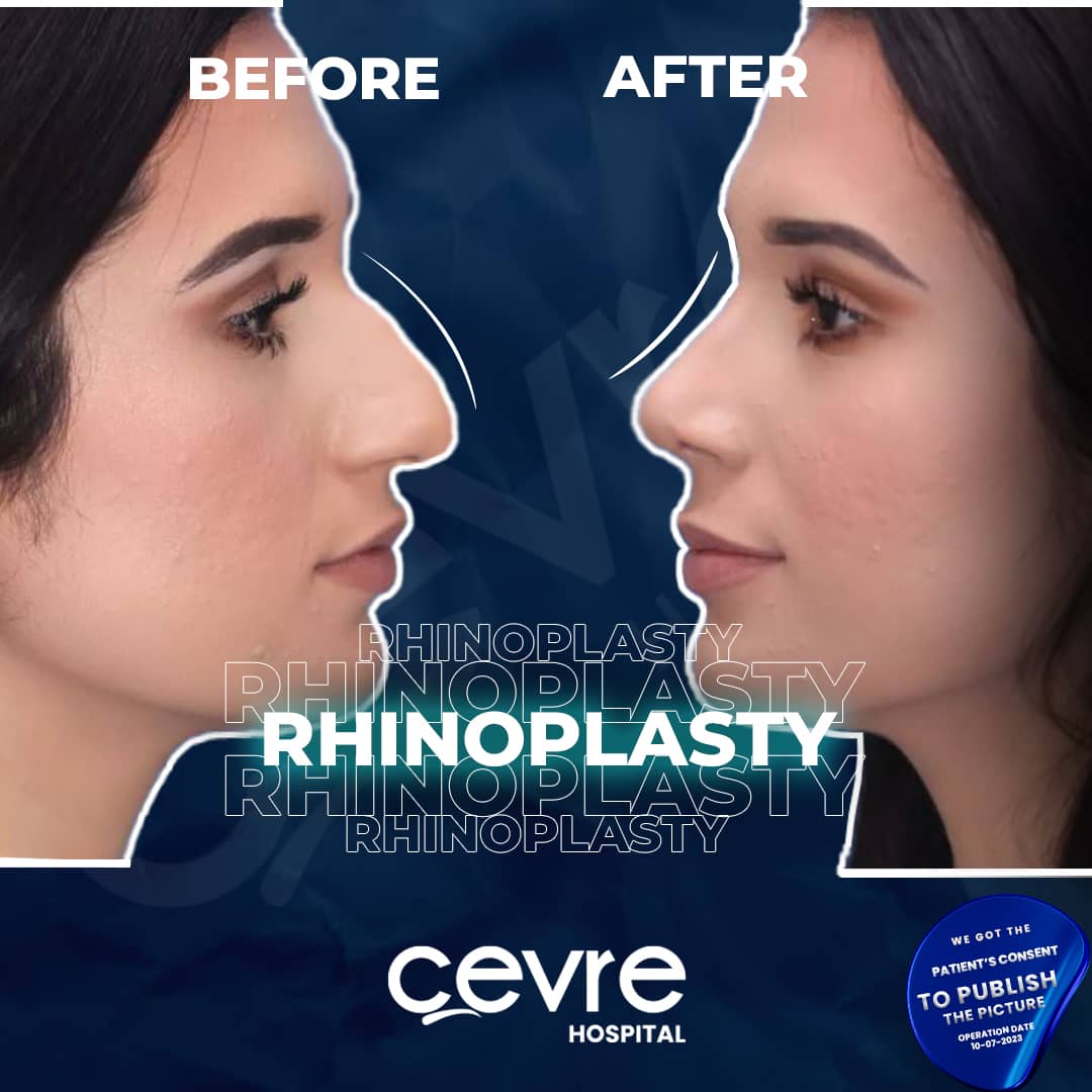 before_and_after_rhinoplasty_in_turkey_by_cevre_hospital (4)-min