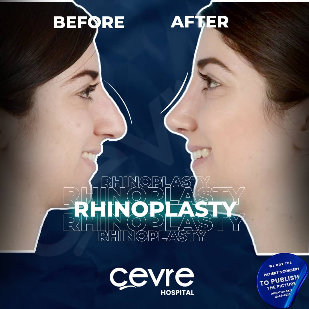 before_and_after_rhinoplasty_in_turkey_by_cevre_hospital (6)-min