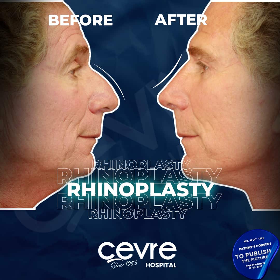 before_and_after_rhinoplasty_in_turkey_by_cevre_hospital-min