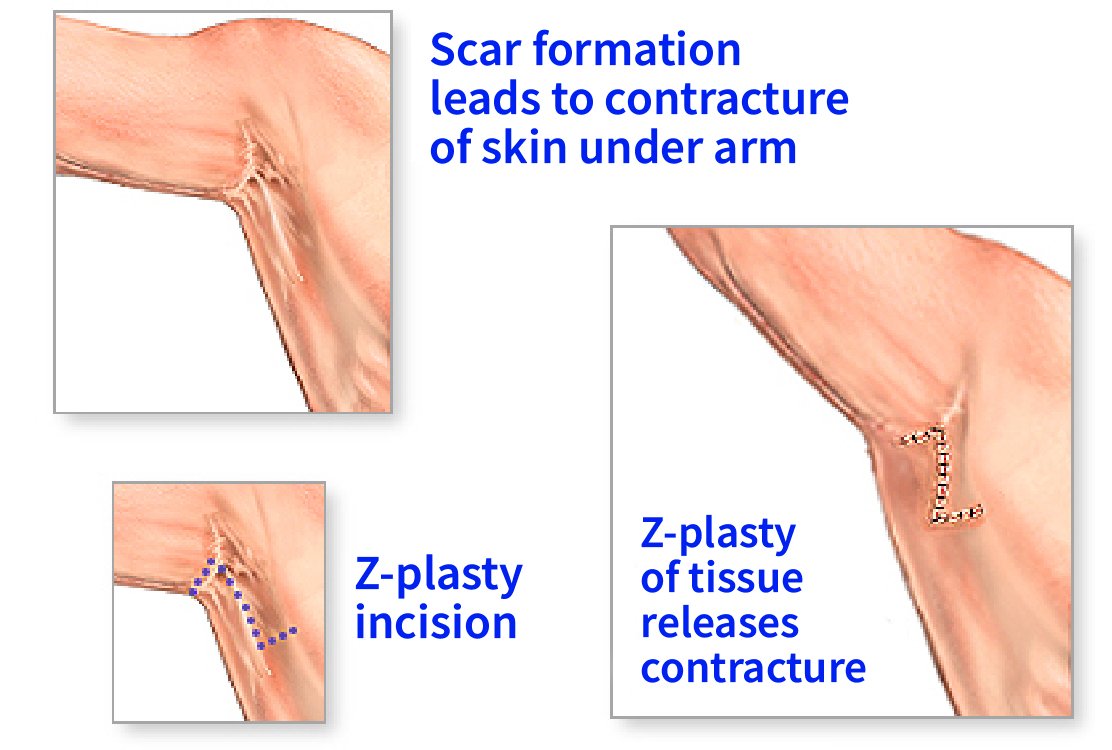 before_and_after_scar_revision_in_turkey (1)