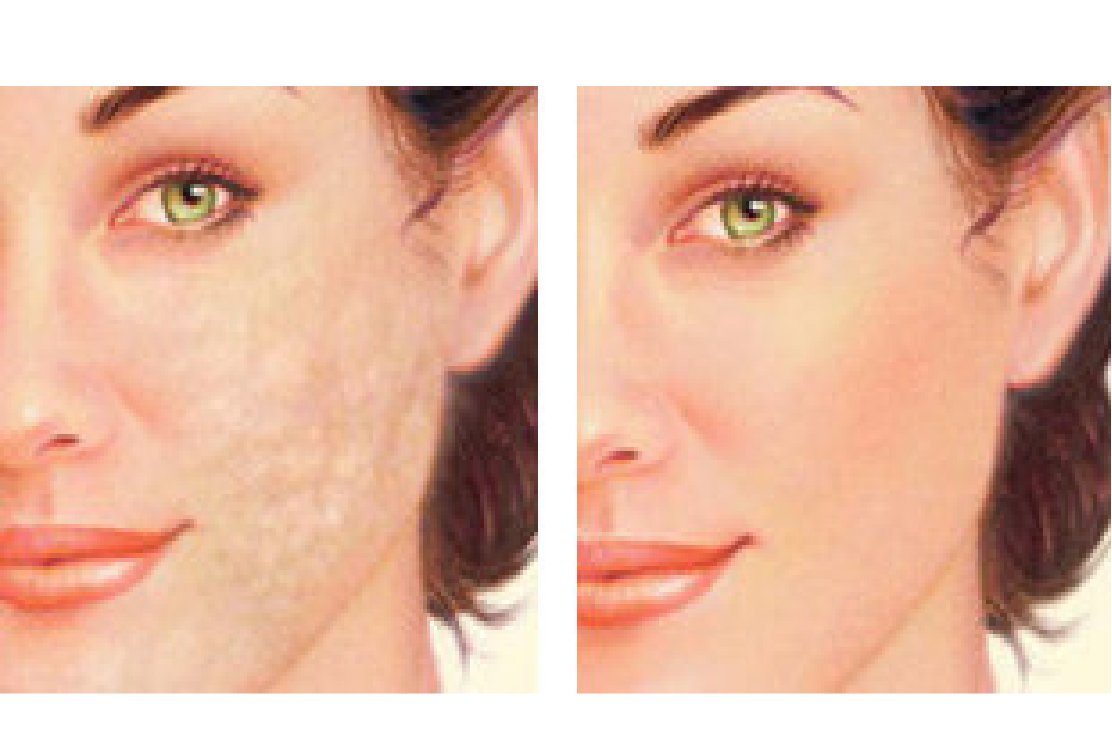 BEFORE_AND_AFTER_SCAR_REVISION_IN_TURKEY