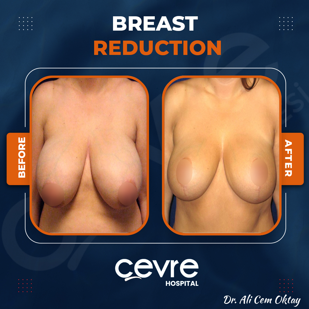 breast_reduction_in_turkey_before_and_after_with_cevre_hospital (2)