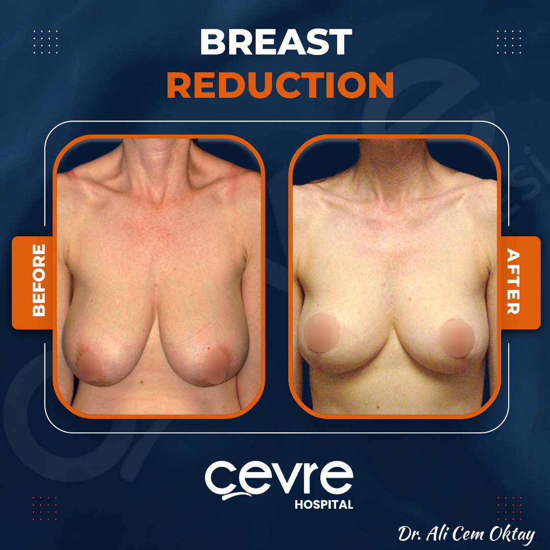 breast_reduction_in_turkey_before_and_after_with_cevre_hospital (5)