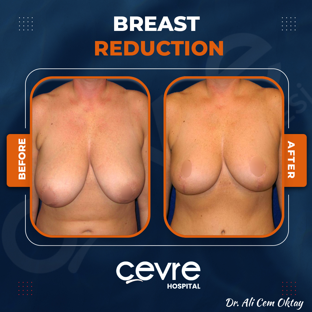breast_reduction_in_turkey_before_and_after_with_cevre_hospital