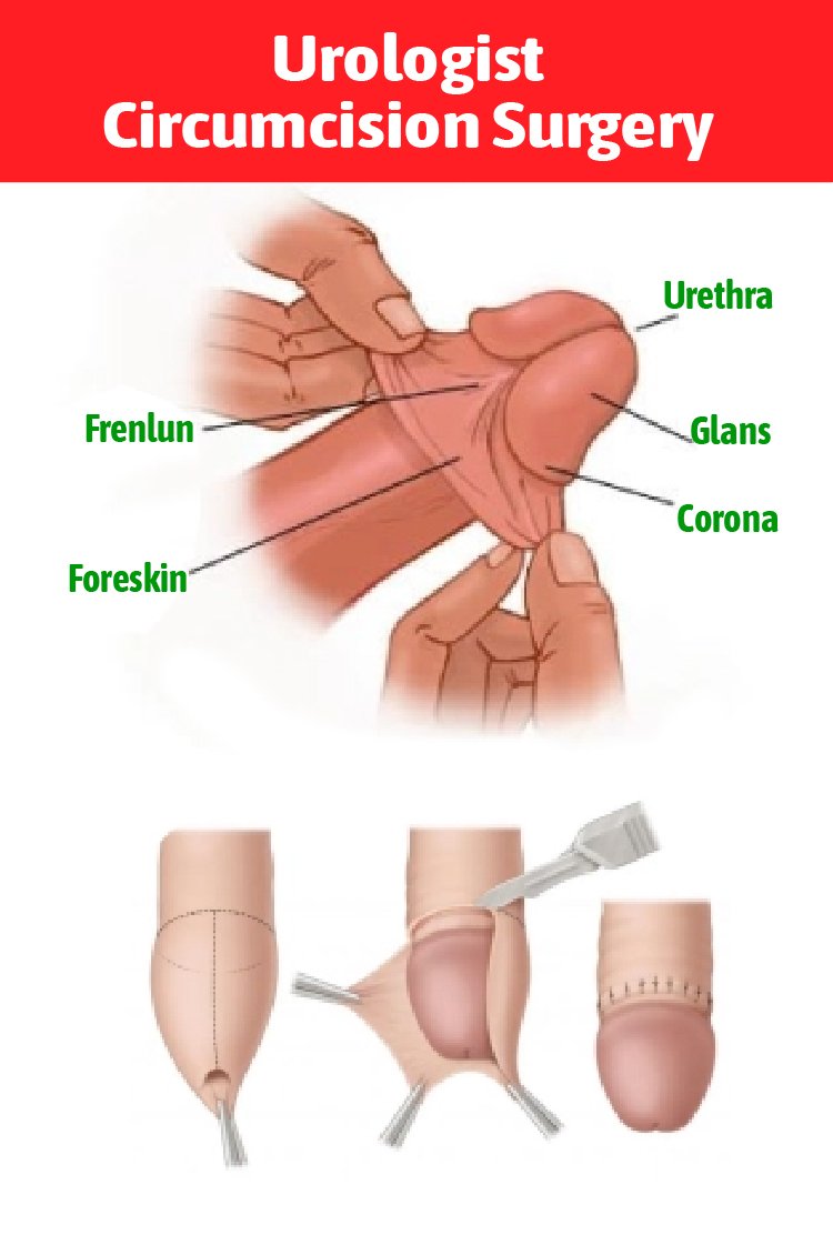 circumcision_in_turkey_procedure (1)