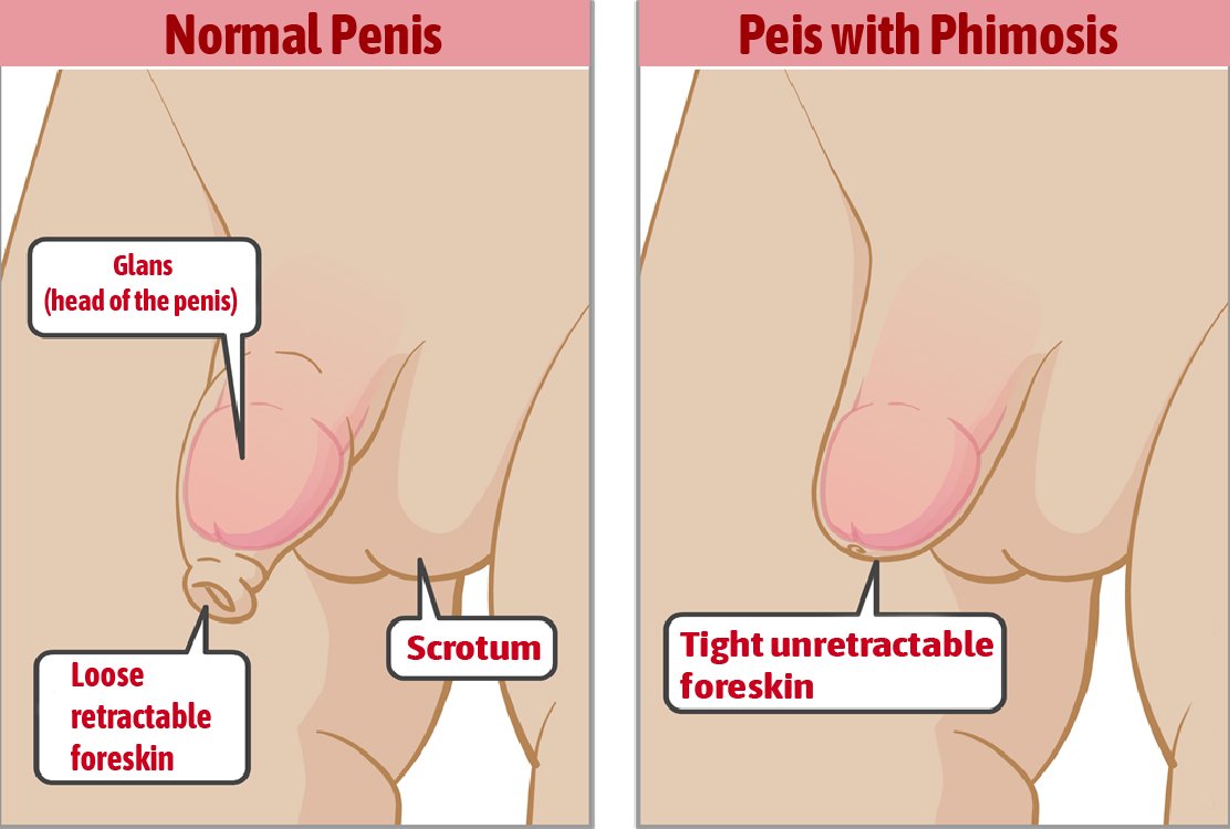 circumcision_in_turkey_procedure