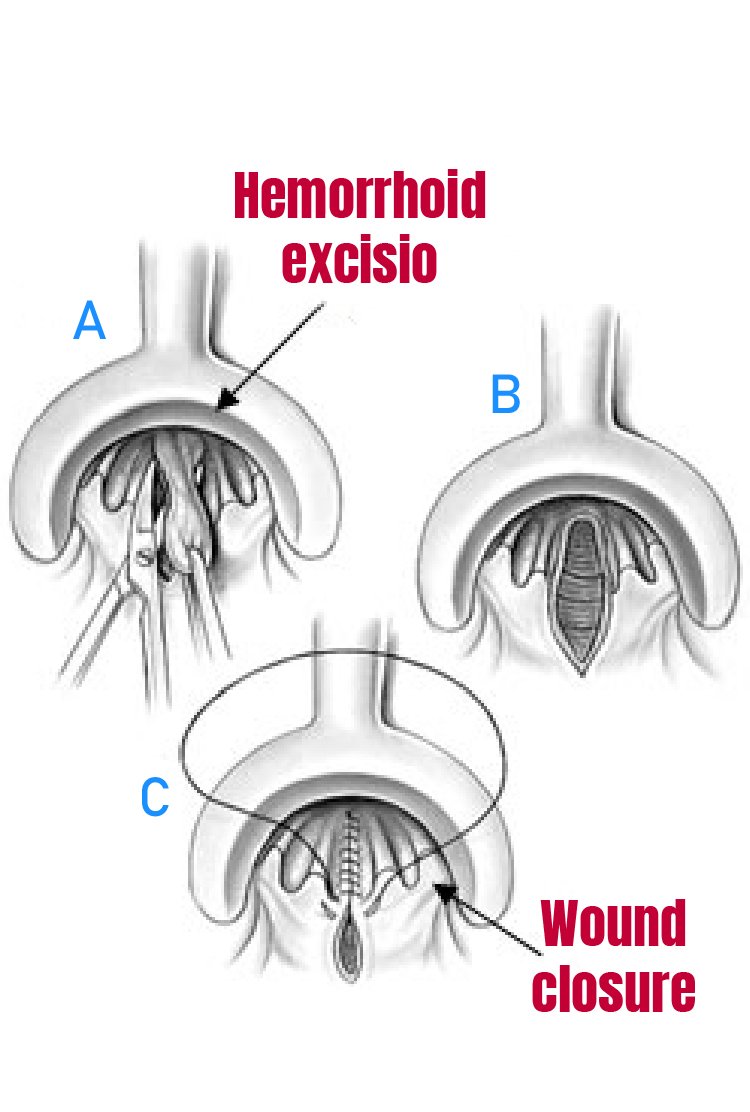 conventional_hemorrhoidectomy_in_turkey