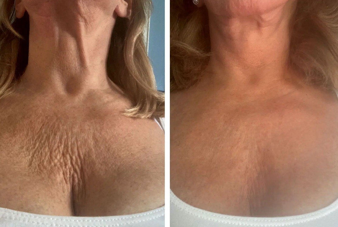 decoletage_lift_for_anti_aging_treatment_in_turkey