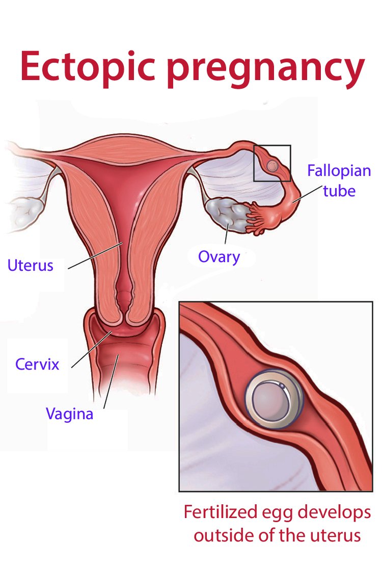 ectopic-pregnancy-for-Tubal-Ligation-in-Turkey