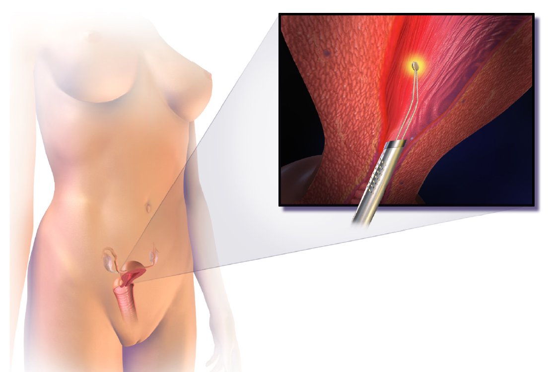 Endometrial-ablation-for-Hysterectomy-in-Turkey