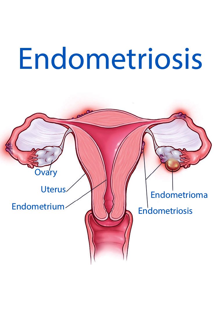 endometriosis-for-Hysterectomy-in-Turkey