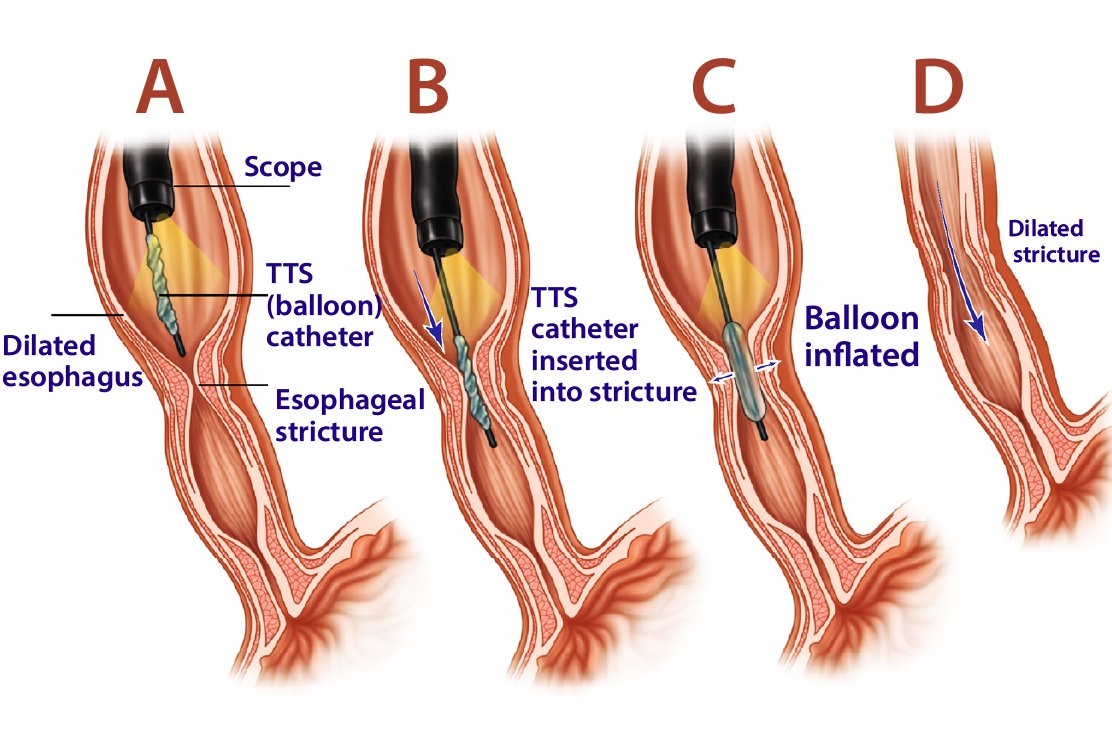 Esophageal-Dilation-for-Esophageal-Surgery
