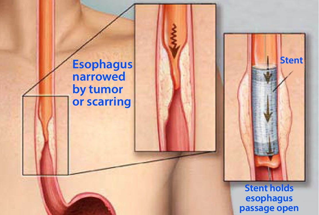 Esophageal-Stent-Placement-for-Esophageal-Surgery
