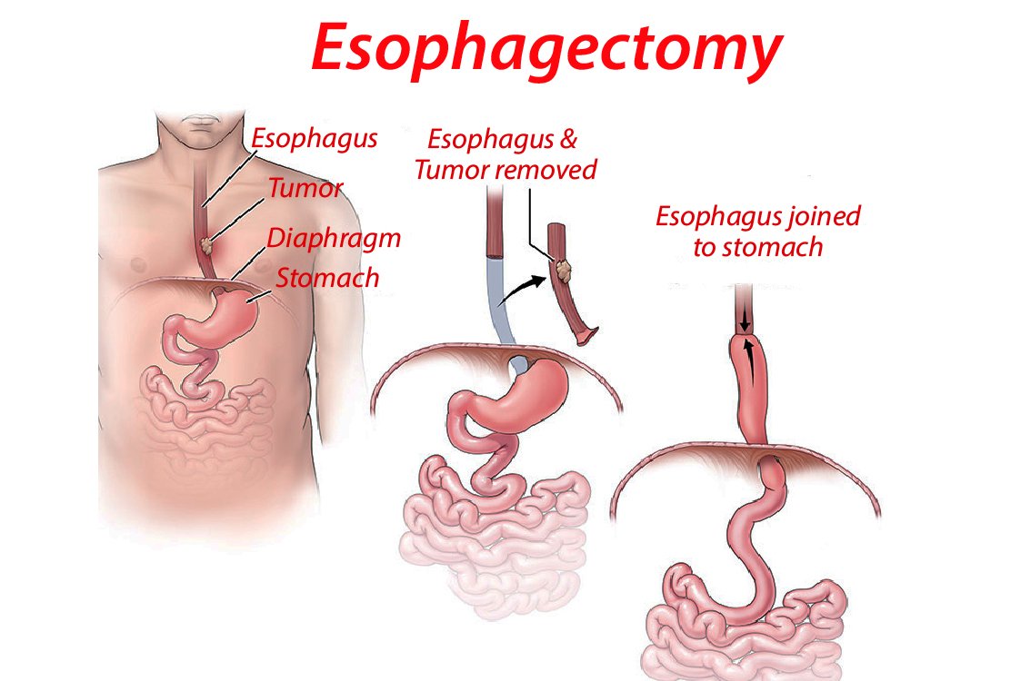 Esophagectomy-fo-Esophageal-Surgery