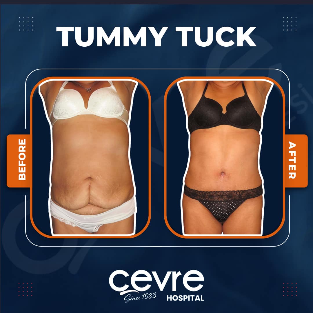 female_tummy_tuck_in_turkey_before_and_after_with_cevre (2)
