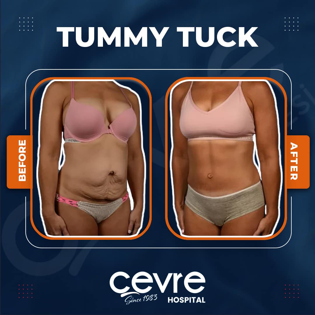 female_tummy_tuck_in_turkey_before_and_after_with_cevre (4)