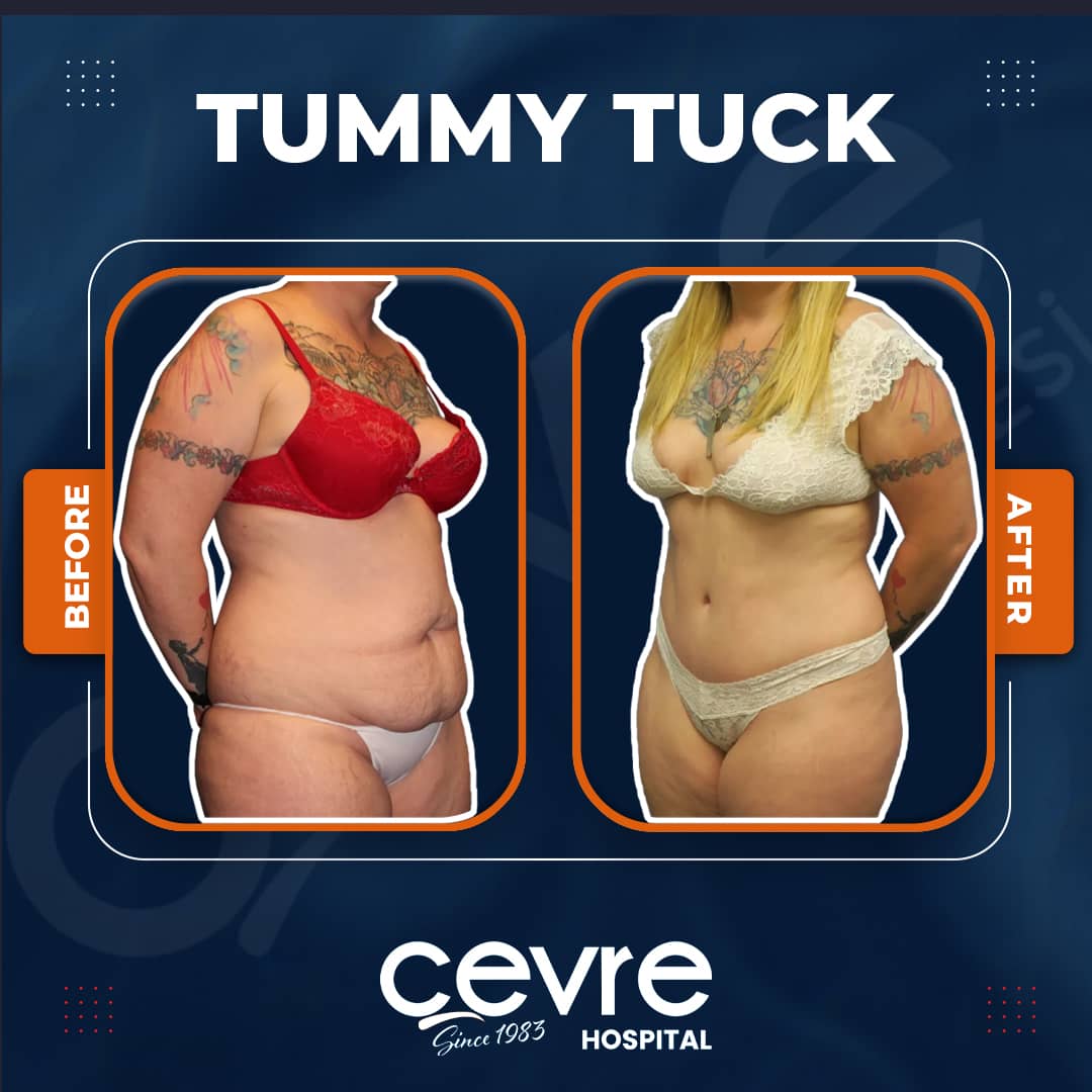female_tummy_tuck_in_turkey_before_and_after_with_cevre (6)