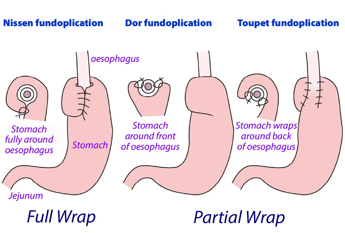 Fundoplication-for-Esophageal-Surgery